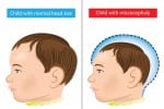 The effects of the Zika virus