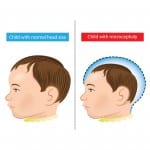 The effects of the Zika virus