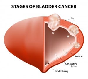 Diabetes drug could increase bladder cancer risk