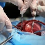 HIV Organ Transplant: historical first!