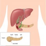 Diagram showing a cancerous tumour on the pancreas