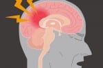 Find out how you could prevent a stroke